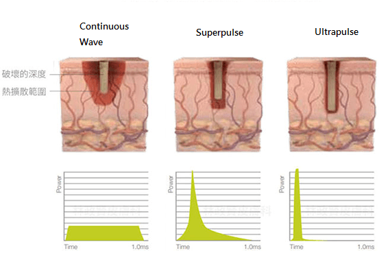 Ultrapulse mode